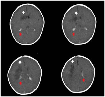 Case report: Neonatal diabetes mellitus caused by KCNJ11 mutation presenting with intracranial hemorrhage